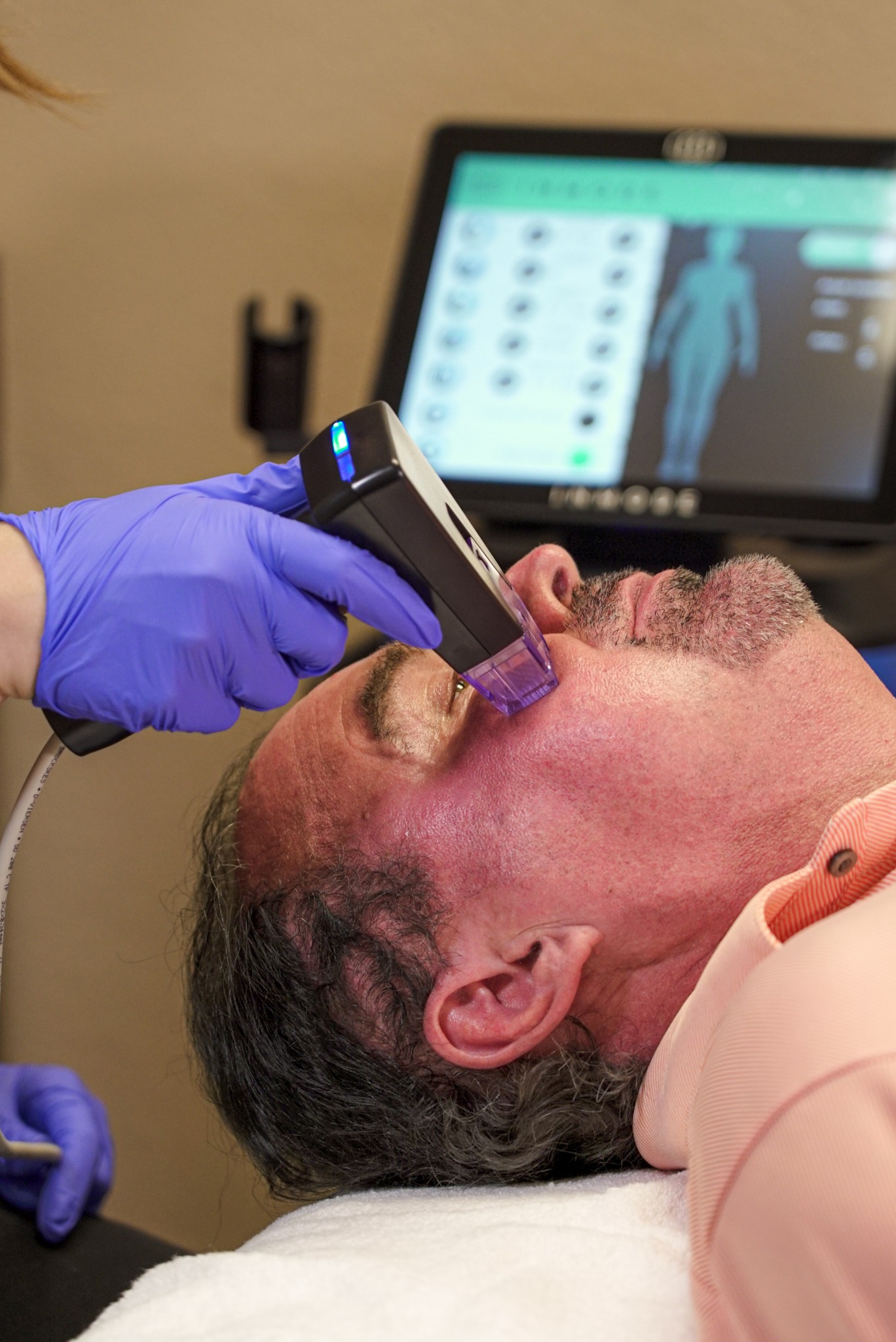 Morpheus8 radiofrequency microneedling treatment in Fort Worth